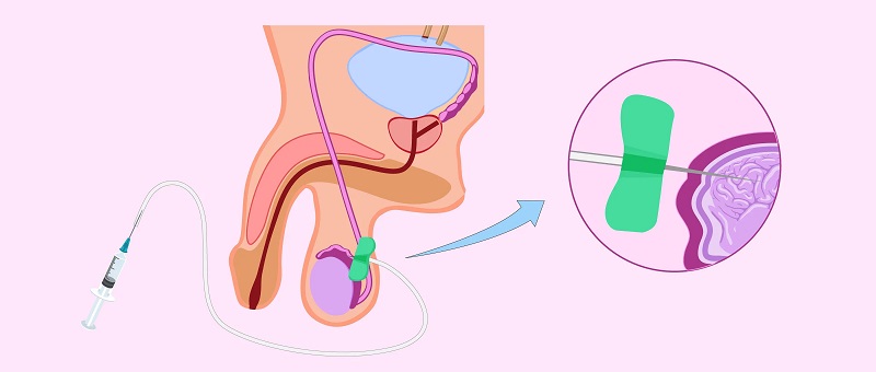 Chọc hút tinh trùng từ mào tinh là kỹ thuật được nhiều Trung tâm hỗ trợ sinh sản áp dụng.