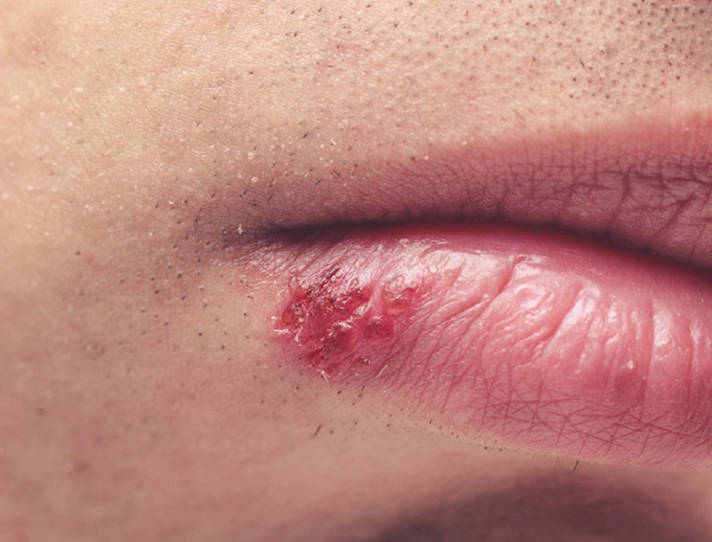 Virus herpes có thể xuất hiện cả ở trên môi người bệnh.