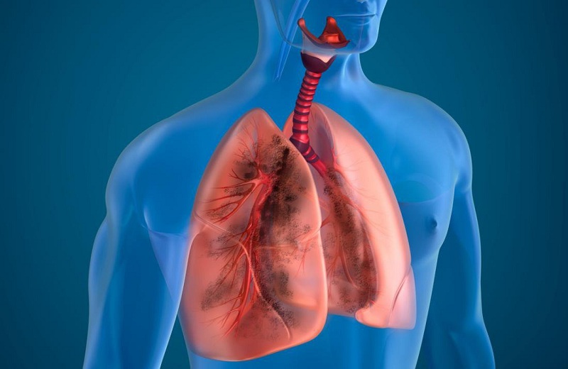 Bệnh phổi tắc nghẽn mãn tính là tình trạng đường thở bị thu hẹp so với bình thường
