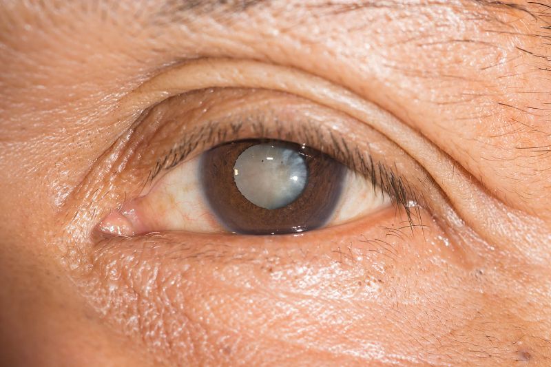 Đục thủy tinh thể là một trong những nguyên nhân gây ra chứng mù đêm