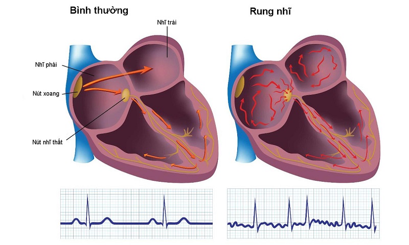 Hình ảnh mô phỏng nhịp tim bình thường và khi bị rung nhĩ.