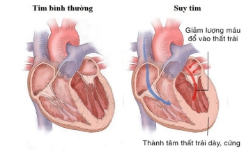 Suy tim phải: Nguyên nhân, dấu hiệu và các biến chứng nguy hiểm