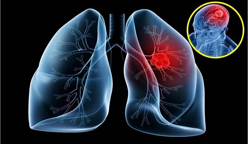 Hình ảnh ung thư phổi tế bào nhỏ (phổi là cơ quan dễ bị tác động bởi khối u ác tính)