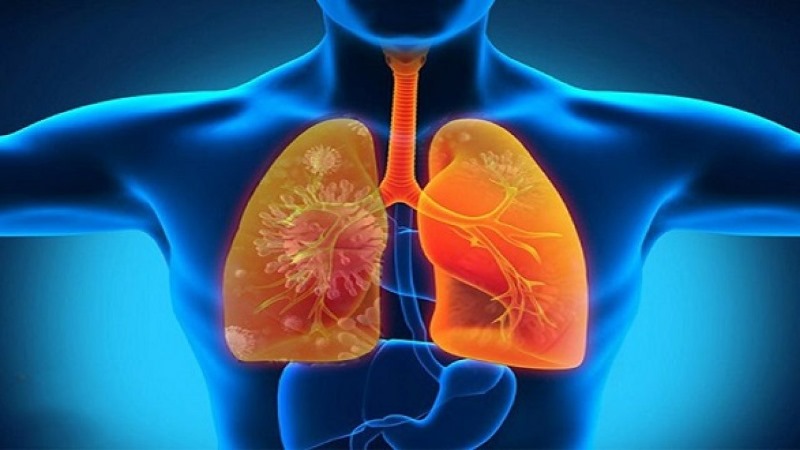 Viêm phổi hít là tình trạng nhiễm trùng phổi bởi vì hít phải thứ gì đó