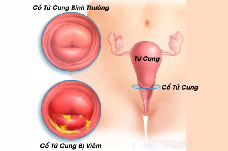 Hiện tượng viêm tái tạo ở cổ tử cung xảy ra ở nữ giới 
