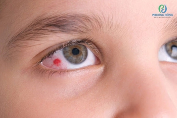 Xuất huyết mắt có nguy hiểm không và phải xử lý như thế nào?