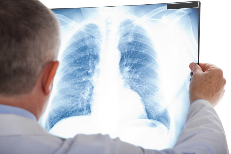 Bệnh phổi kẽ là tình trạng tổ chức kẽ của phổi bị tổn thương 