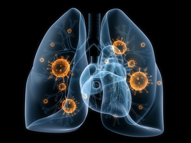 Nấm, virus và vi khuẩn là tác nhân chính gây ra bệnh phổi kẽ