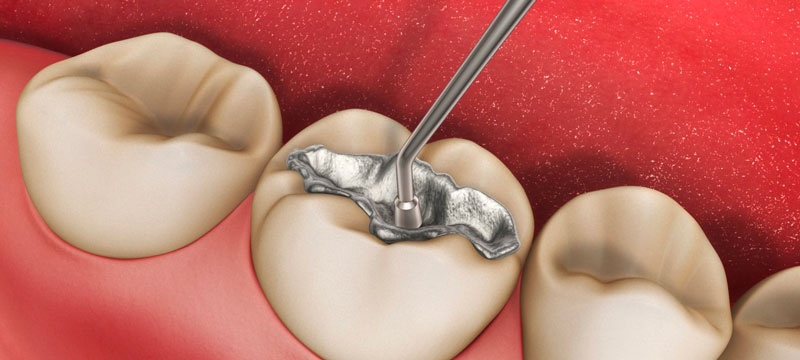 Hàn răng là phương pháp nha khoa phổ biến hiện nay