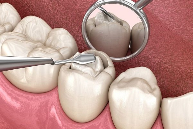 Hàn răng thường không gây ra đau đớn cho người bệnh