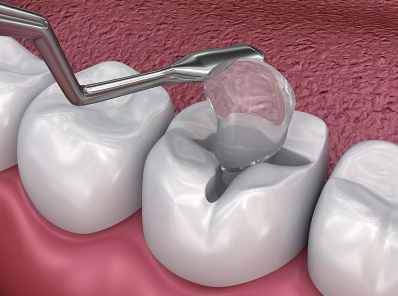 Hàn răng đảm bảo tính thẩm mỹ và chức năng nhai