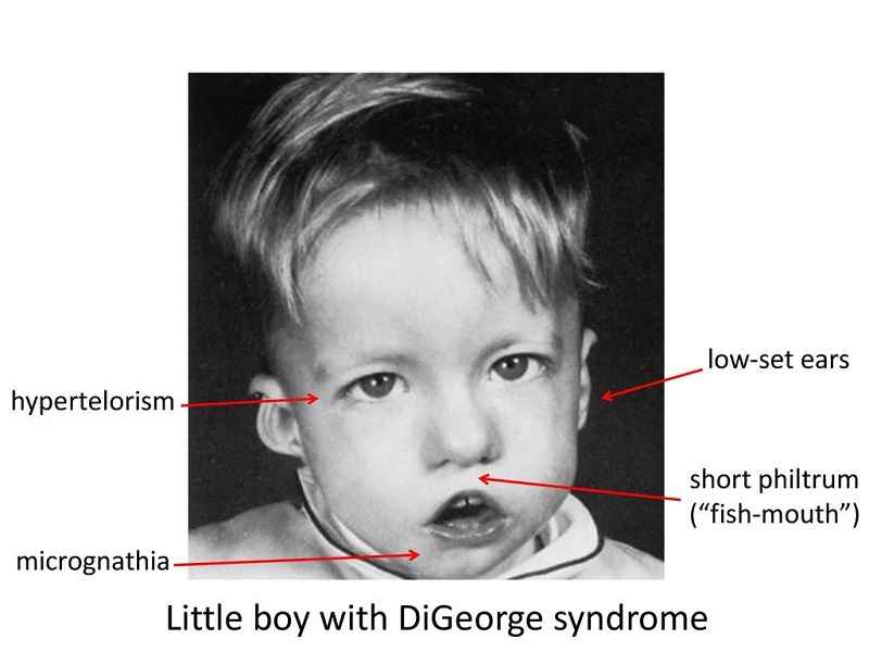 Hình ảnh trẻ nhỏ bị mắc phải hội chứng DiGeorge 