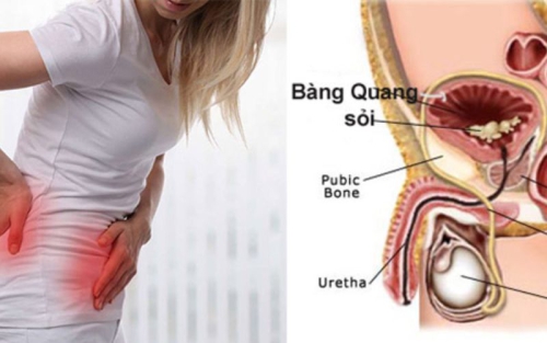 Thủ thuật nội soi bàng quang đang phổ biến hiện nay