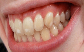 Nguyên nhân răng nhiễm Tetracycline và cách khắc phục hiệu quả 