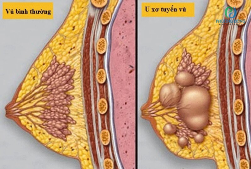Sinh thiết vú giúp xác định khối u vú là u lành tính hay ung thư ác tính để có kế hoạch điều trị sớm.