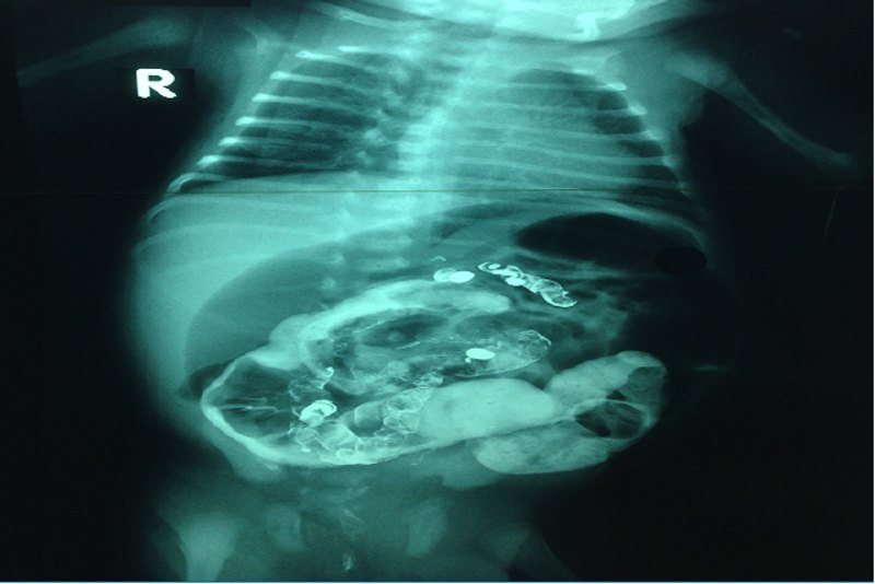 Tắc ruột ở trẻ sơ sinh được chẩn đoán qua hình ảnh chiếu chụp