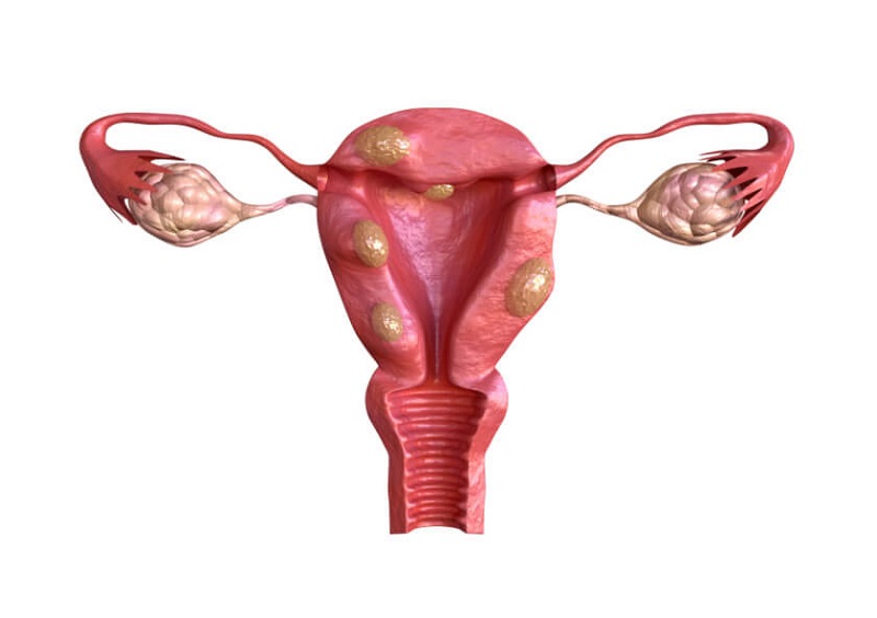 U xơ tử cung là bệnh thường gặp ở phụ nữ độ tuổi sinh nở.