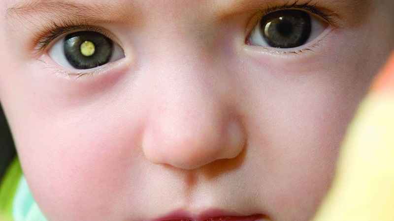 Bệnh u nguyên bào võng mạc mắt được phân loại thành nhiều nhóm khác nhau