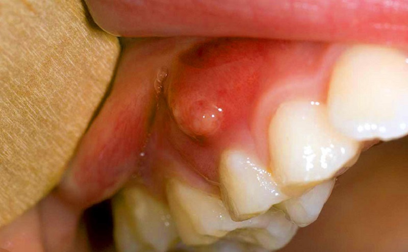 U răng là bệnh lý tiềm ẩn nhiều rủi ro cho người bệnh
