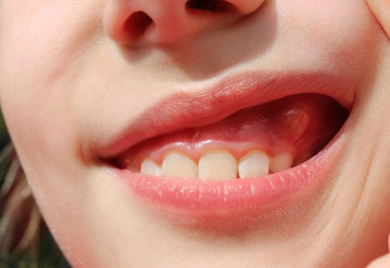 U nang chân răng khó phát hiện ở giai đoạn sớm