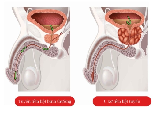 U xơ tiền liệt tuyến: Dấu hiệu nhận biết và điều trị