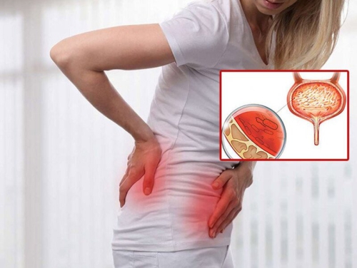 Viêm bàng quang xuất huyết- nguyên nhân và cách điều hòa trị