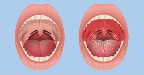 Viêm họng do liên cầu khuẩn: Nguyên nhân, triệu chứng và điều trị