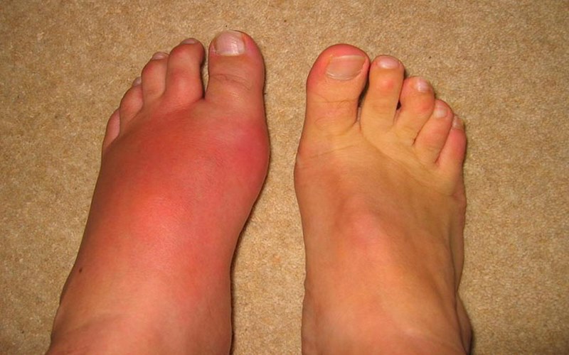 Viêm khớp bàn chân là bệnh lý khá phổ biến