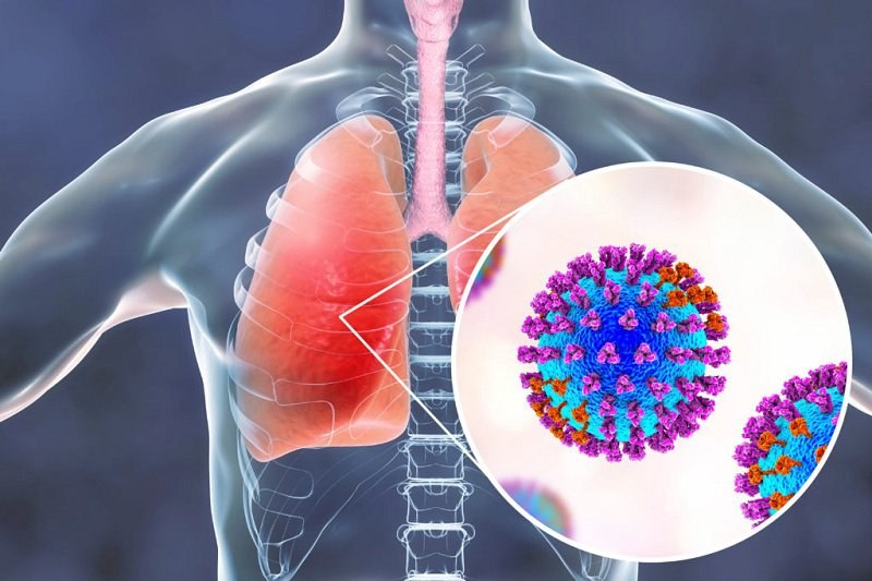 Viêm phổi do vi khuẩn là tình trạng phổi bị viêm bởi vì nhiễm khuẩn 