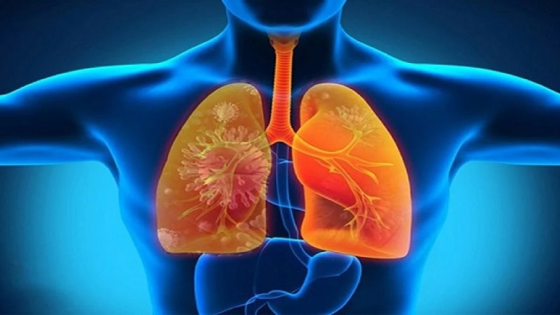 Có một số người sẽ có nguy cơ cao mắc phải viêm phổi do vi khuẩn