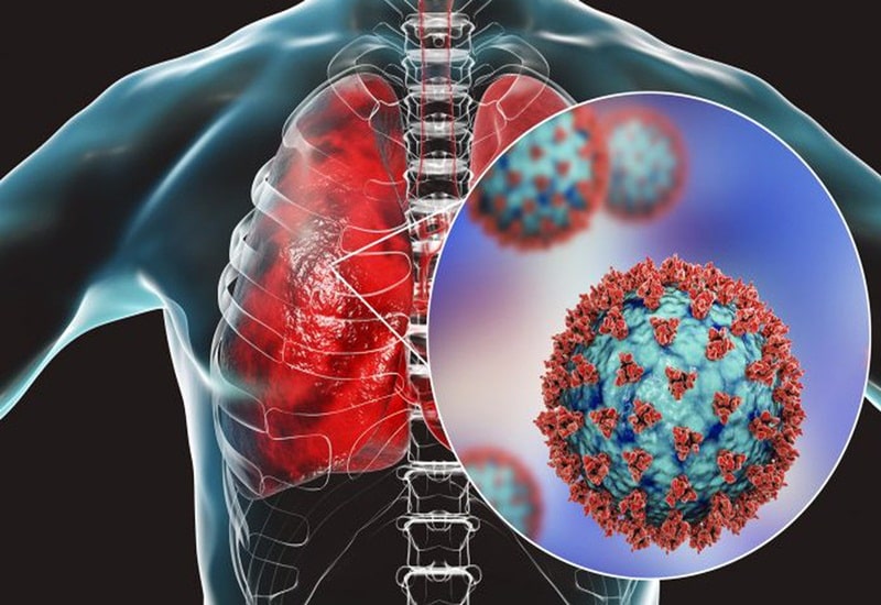 Hiểu thế nào viêm phổi do nhiễm virus