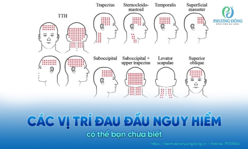 Các vị trí đau đầu nguy hiểm có thể bạn chưa biết