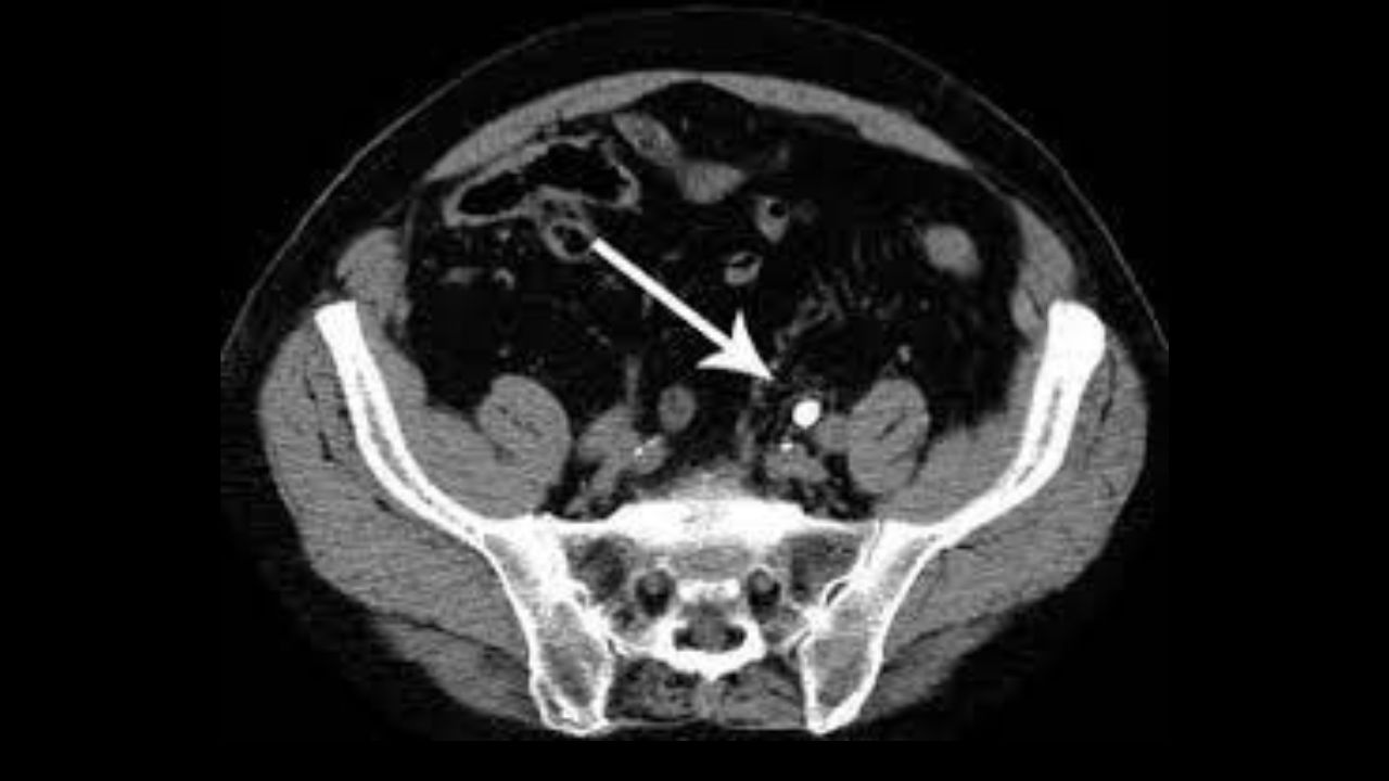 (Hình ảnh chụp CT thận có độ chính xác rất cao trong chẩn đoán sỏi thận)