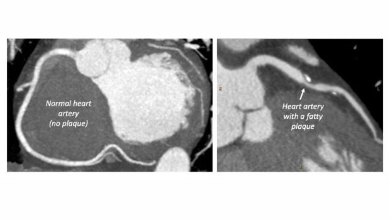 (Minh hoạ ảnh chụp CT tim có động mạch bình thường và động mạch có mảng bám mỡ)