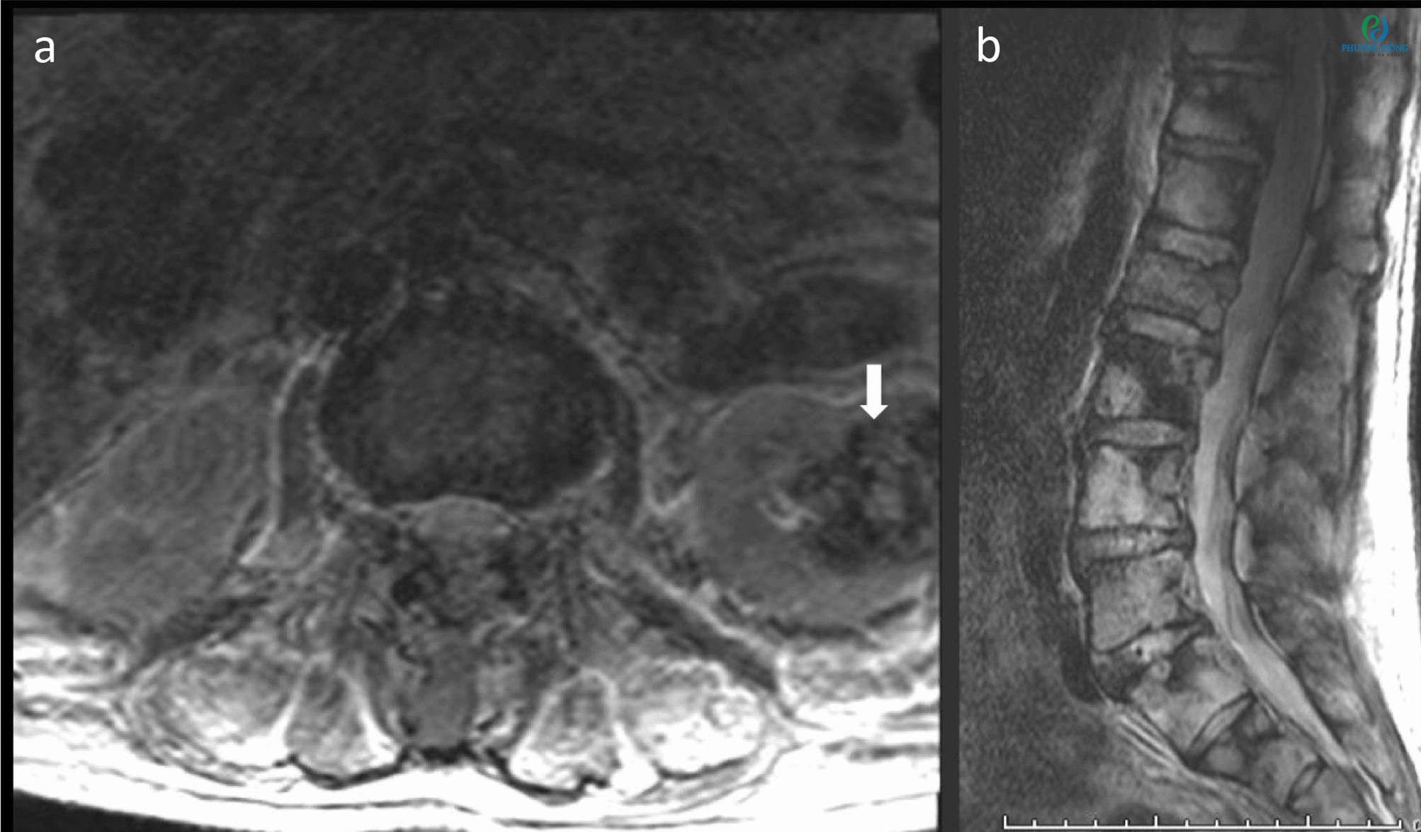 Chụp MRI giúp phát hiện chấn thương và bệnh lý tại cột sống thắt lưng
