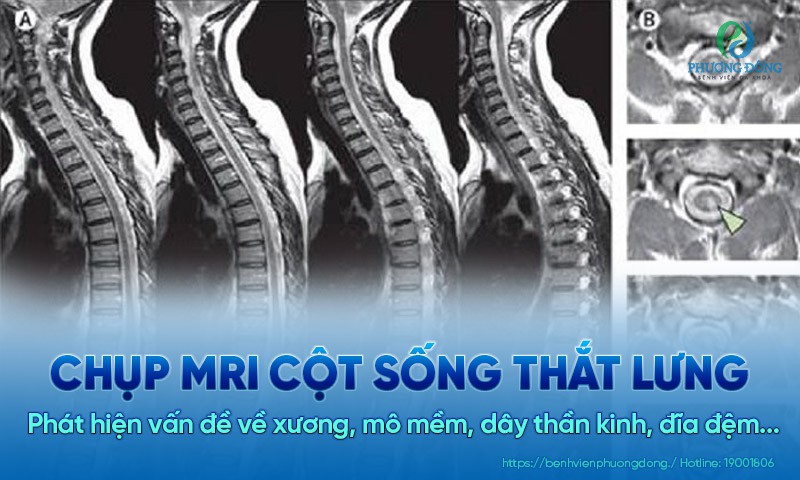 Chụp cộng hưởng từ cột sống thắt lưng phát hiện các vấn đề về xương, mô mềm, dây thần kinh và đĩa đệm