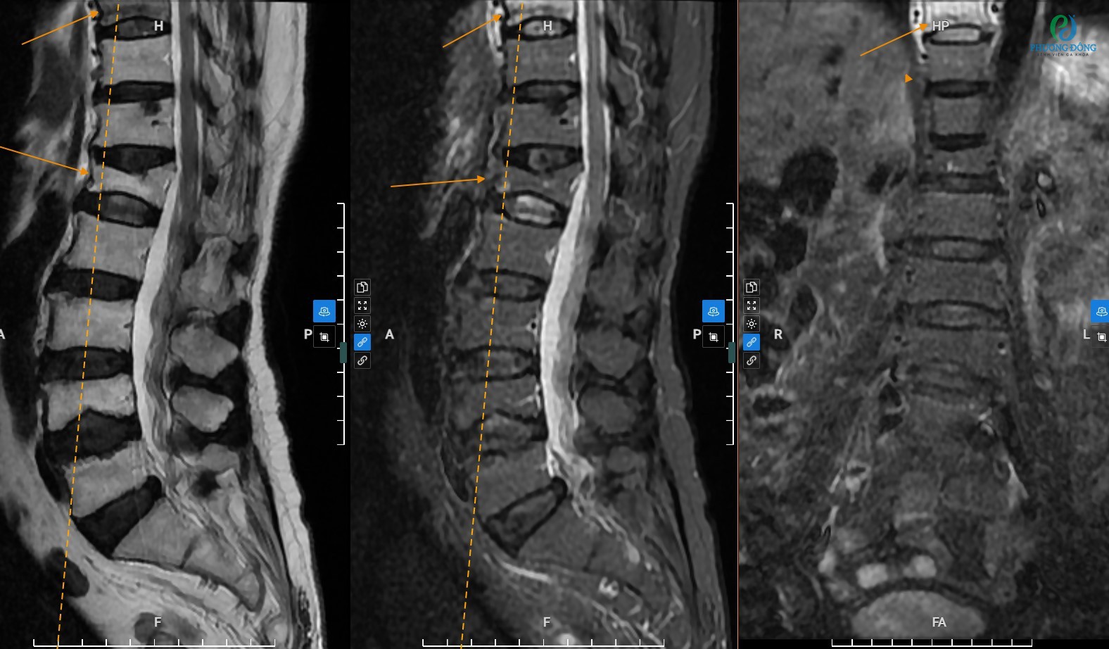 Đánh giá bệnh lý cột sống thắt lưng qua kỹ thuật chụp MRI