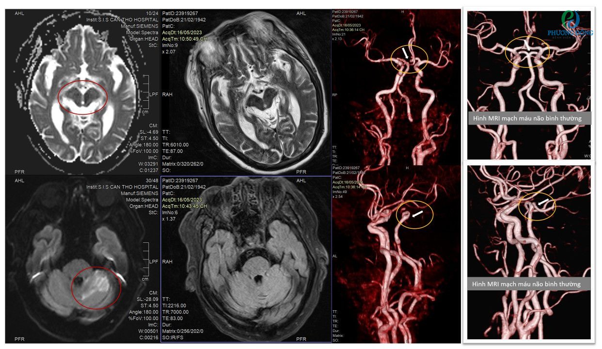 Chỉ định chụp MRI mạch máu não với người thường xuyên đau đầu