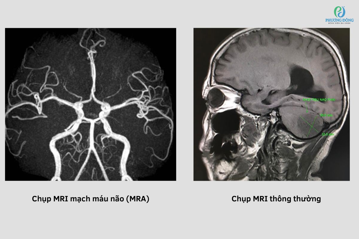 Sự khác biệt giữa chụp MRI thông thường với MRI mạch máu