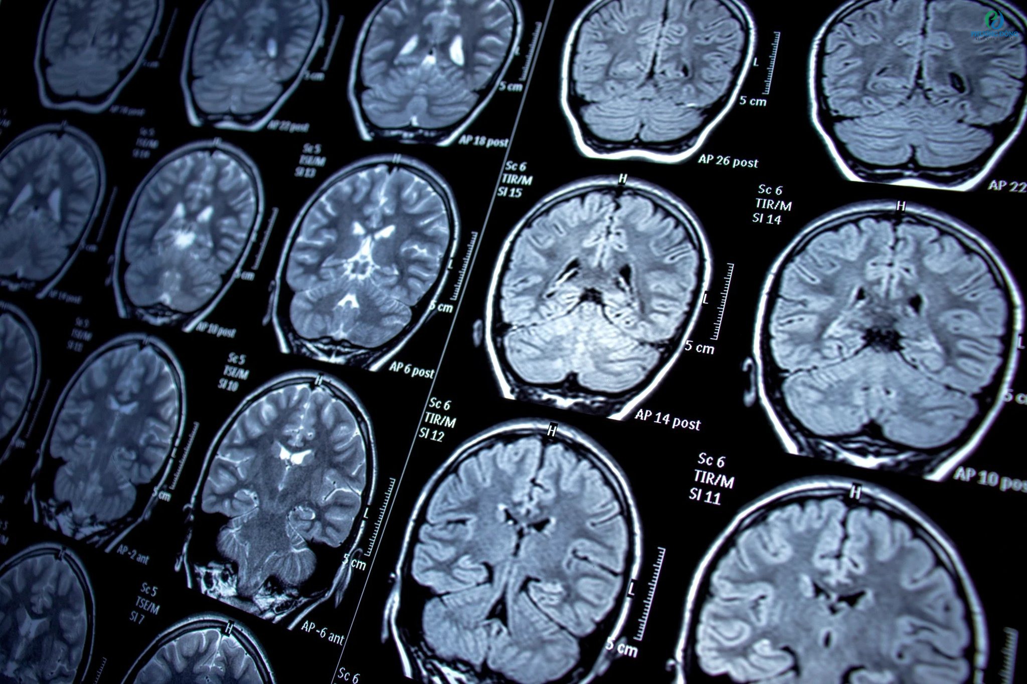 Chụp MRI não thu được hình ảnh cấu trúc chi tiết trong đầu
