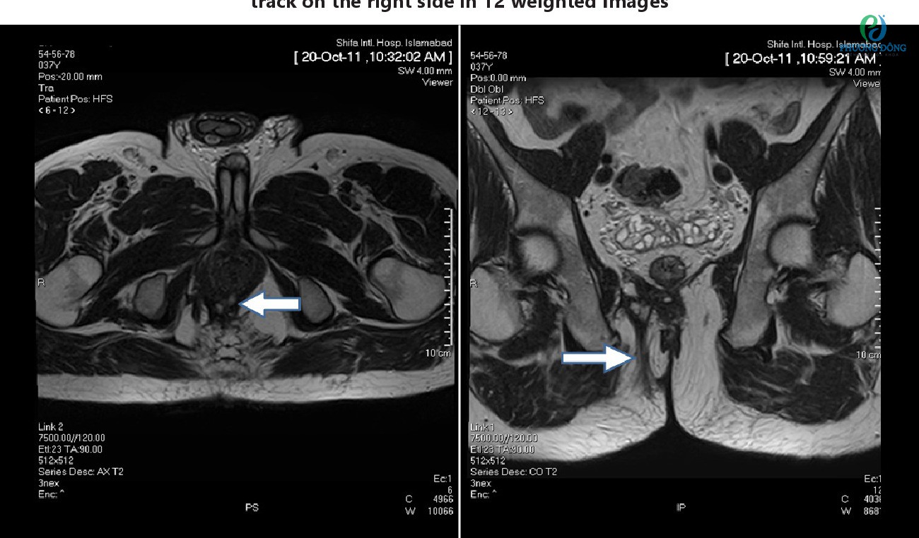 Hình ảnh chụp cộng hưởng từ (MRI) hậu môn