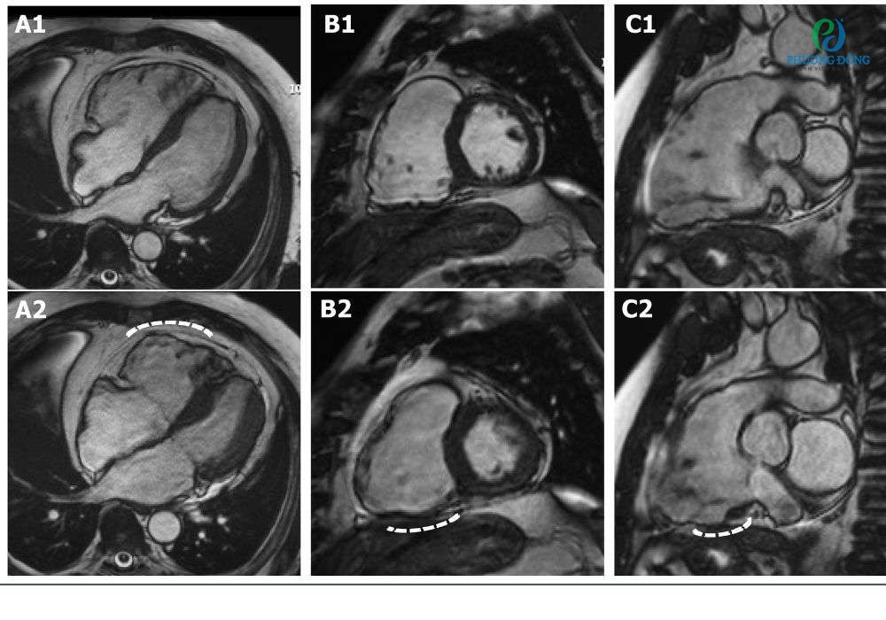 Hình ảnh MRI của bệnh nhân nữ mắc cơ tim thất phải gây rối loạn nhịp tim