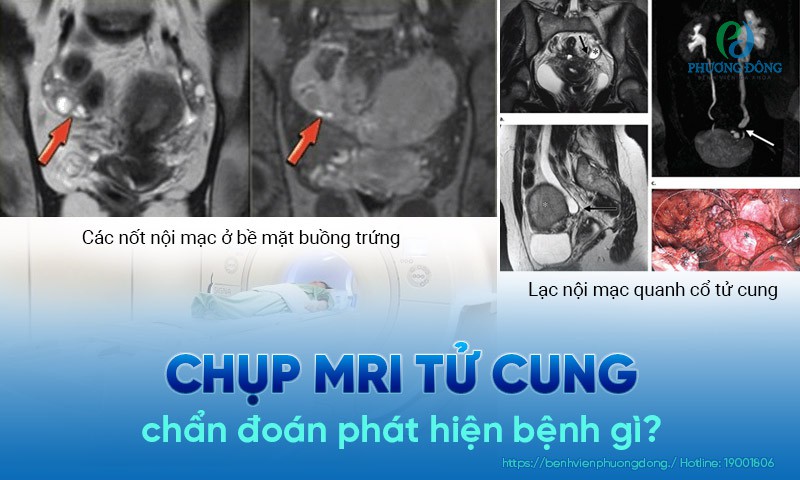 Chụp MRI giúp phát hiện lạc nội mạc tử cung