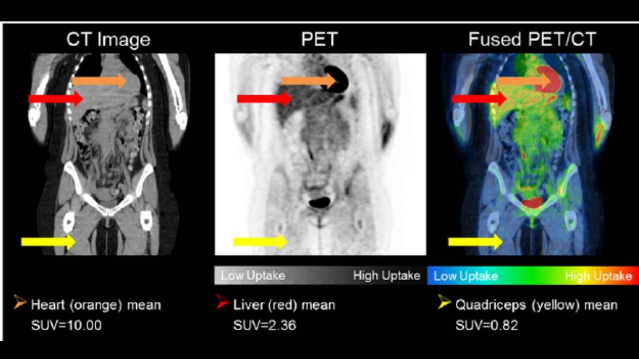                                     (Chụp Pet CT là sự kết hợp của kỹ thuật chụp CT và chụp PET)