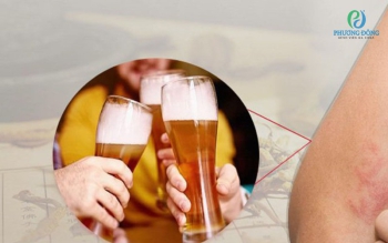Dị ứng bia rượu có nguy hiểm không? 