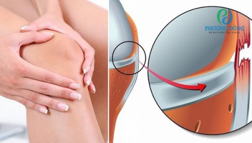 Giãn dây chằng: Nguyên nhân, dấu hiệu, vị trí thường gặp và cách điều trị