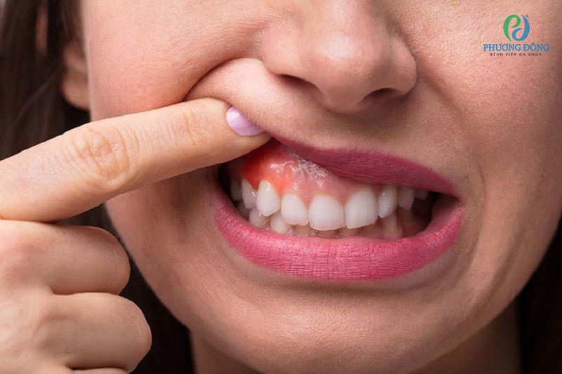 Chữa trị kịp thời các bệnh về răng