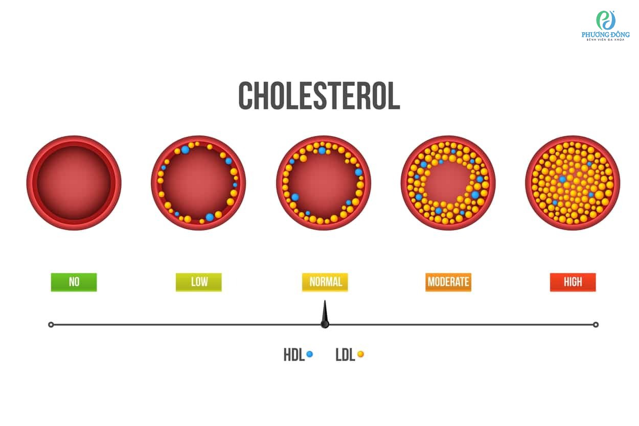 Chỉ số mỡ máu bình thường khi tổng cholesterol dưới 200 mg/dL
