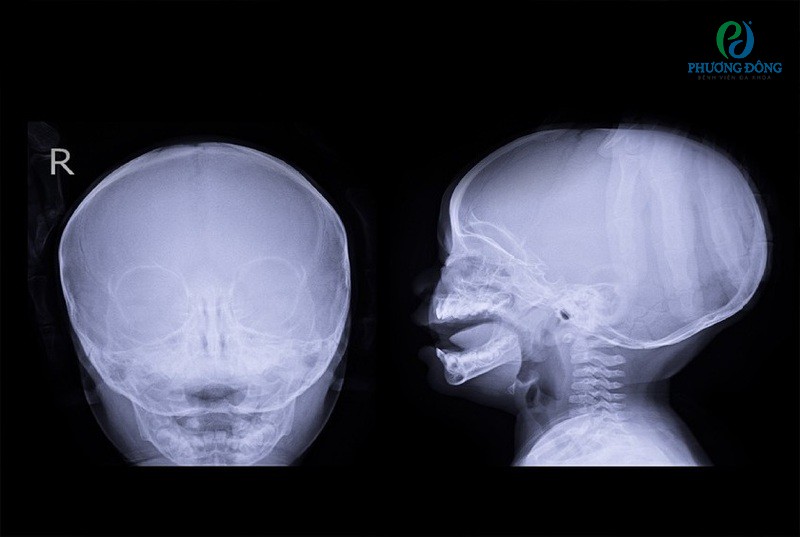 Chụp CT giúp xác định người bệnh có bị não úng thủy hay không 