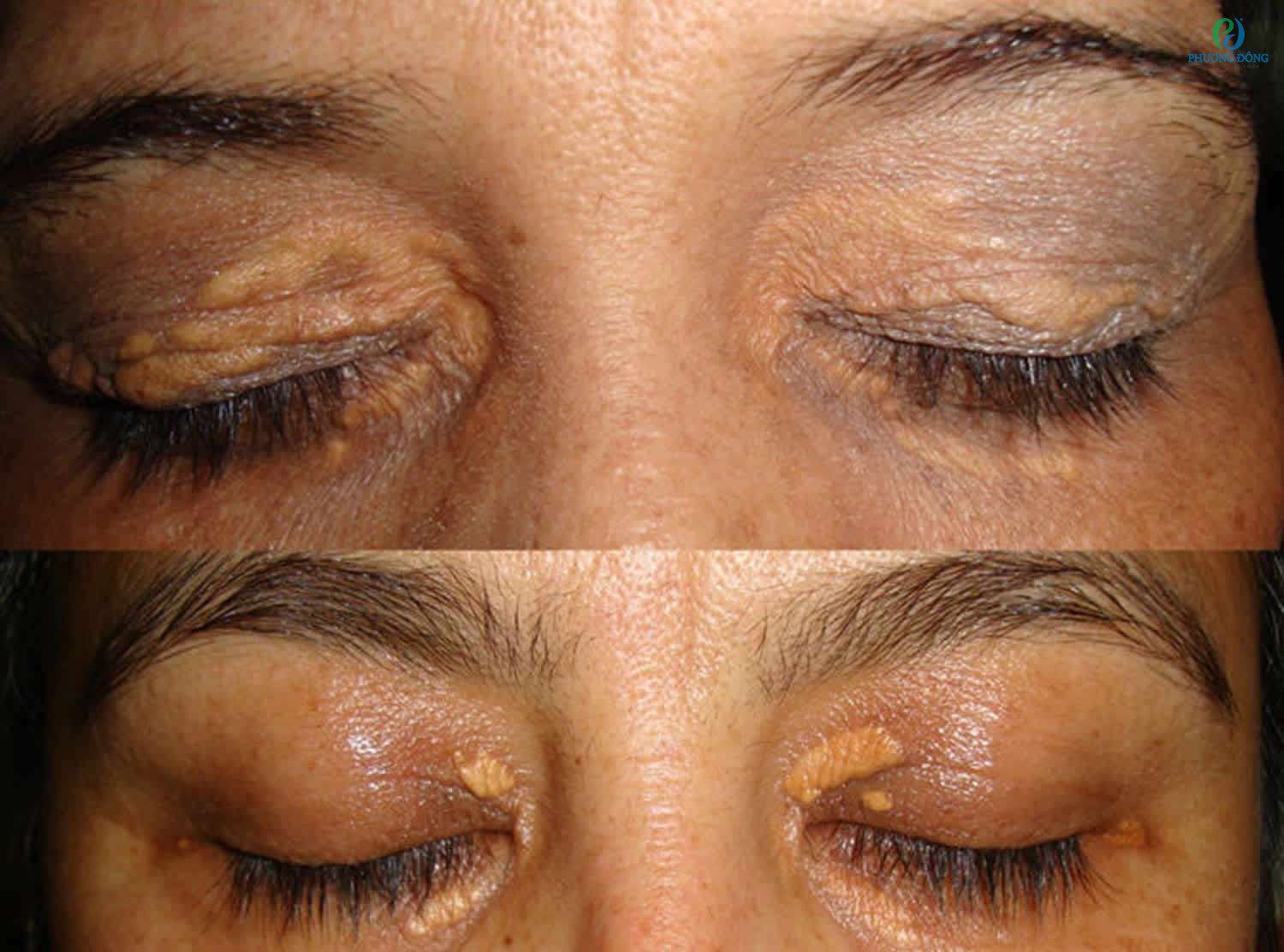 Xuất hiện u vàng xung quanh mắt người bệnh rối loạn lipid máu